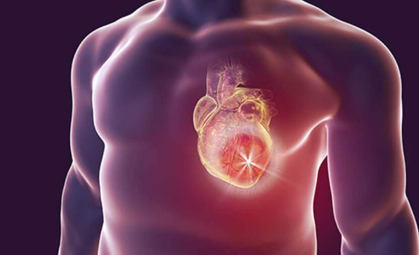 myocardial-infarction-picture